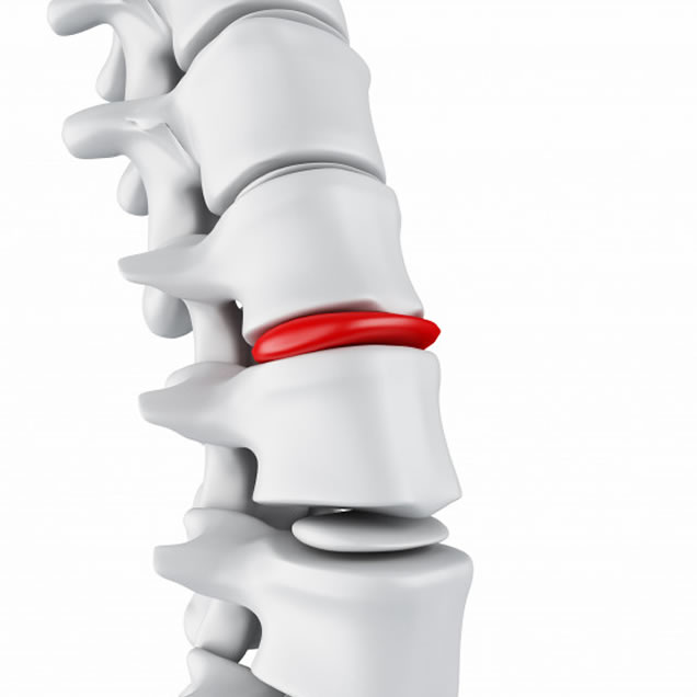 Degenerative disc disease