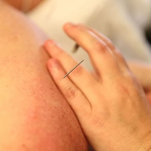 acupuncture